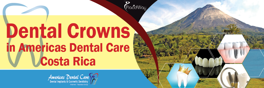 Dental Crowns at Americas Dental Care Costa Rica